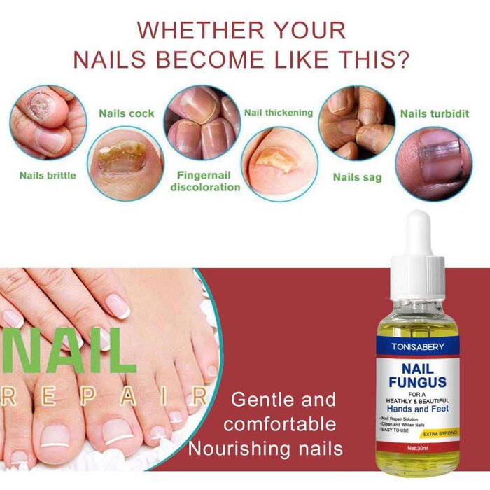 TONISABERY TONISABERY Nail Essence Treatment Solution For Onychomycosis 30mlProduct Thumbnail